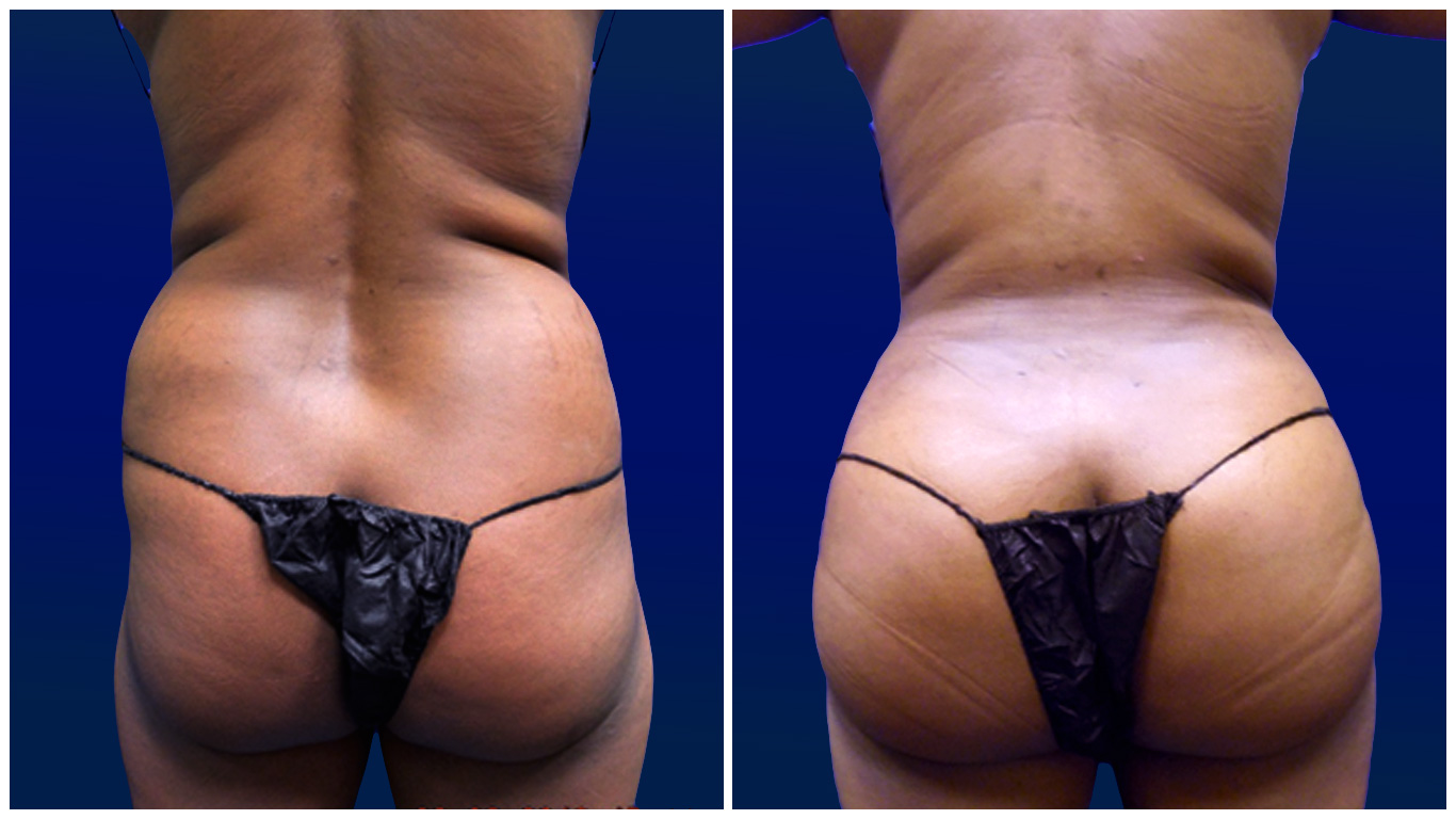 Combining Tummy Tuck and Brazilian Butt Lift