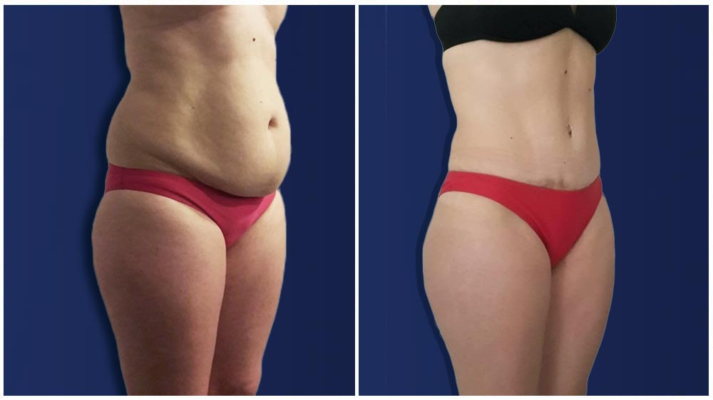 Black Friday Limited Special * Chicago Liposuction