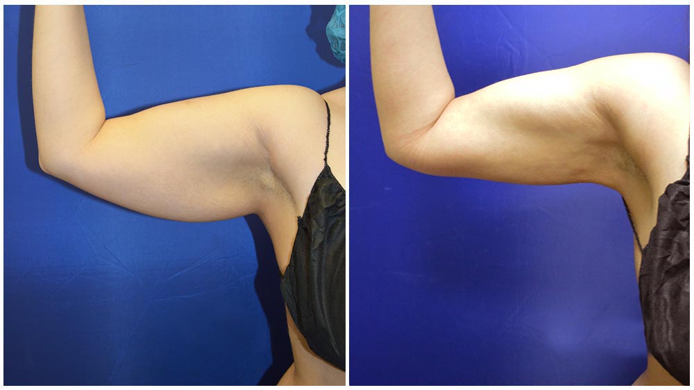 Arm Liposuction Chicago - Chicago Liposuction by Lift Body Center