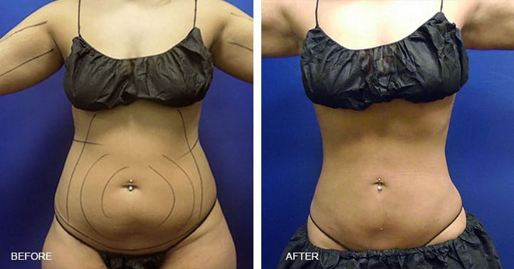 Smartlipo Flanks / Love Handles – Patient 2 Before & After Photos (Women)