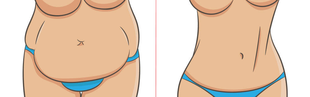 https://www.chicagoliposuction.com/wp-content/uploads/2019/05/Liposuction-vs.-Tummy-Tuck.jpg