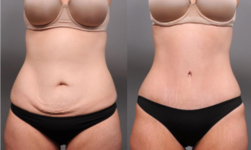 Tummy Tuck / Abdominoplastia - Chicago Liposuction by Lift Body Center
