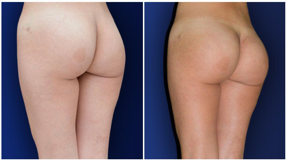 🥇 Can you make a BBL smaller? Why are women seeking liposuction