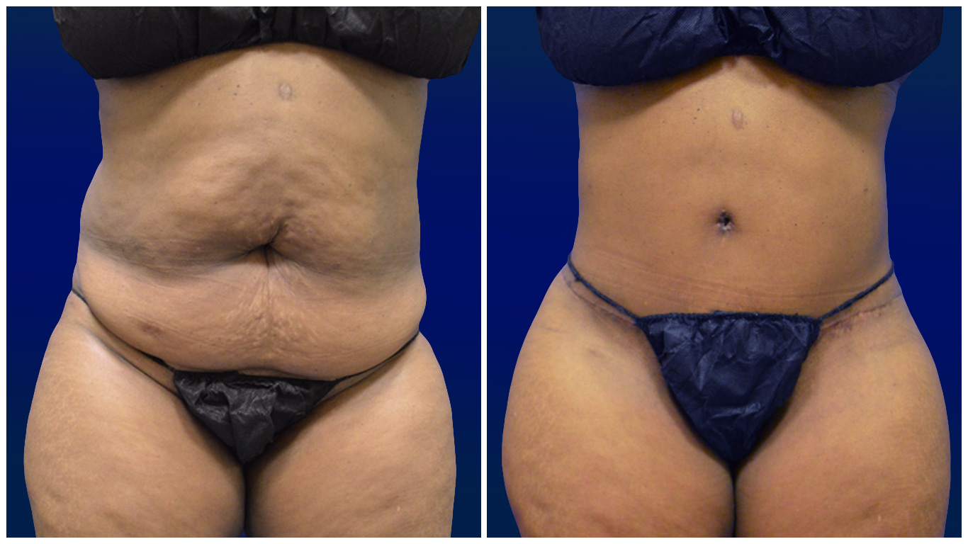 Stomach and Abdomen Liposuction  Abdomen Liposuction Near Charlotte