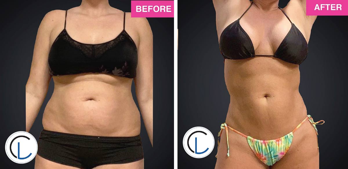 Miracle Skin Tightening® by Renuvion - Chicago Liposuction by Lift