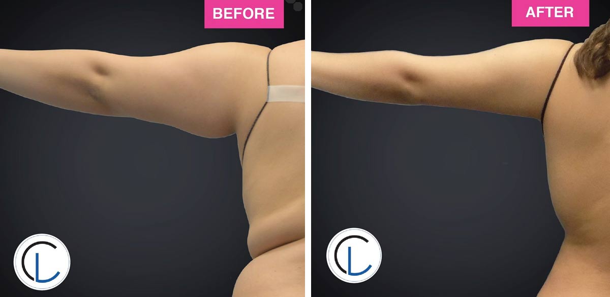 Miracle Tummy Lift - Chicago Liposuction by Lift Body Center