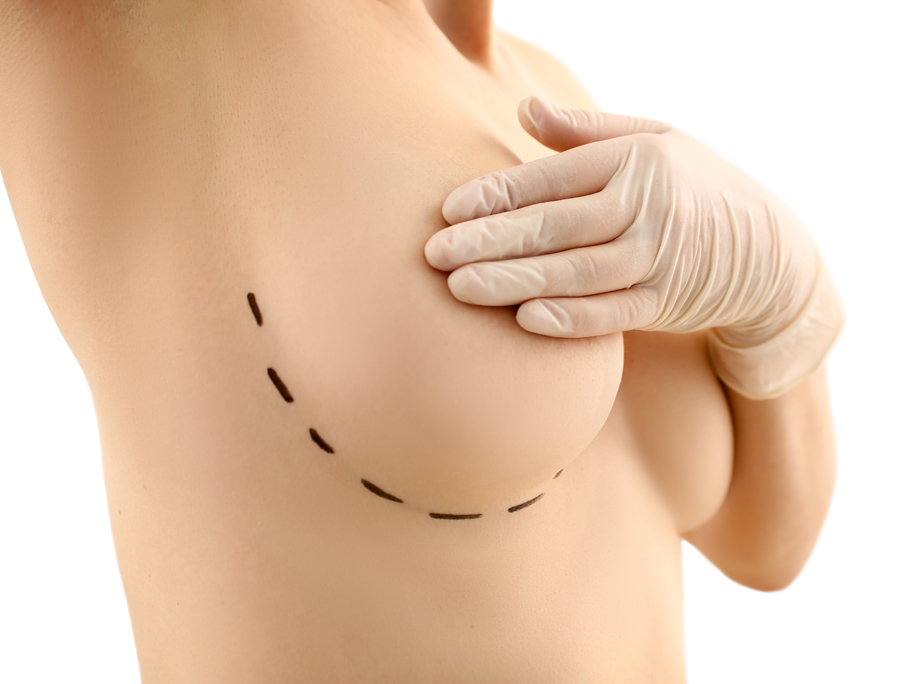 Classification of the tuberous breast deformity. The higher the